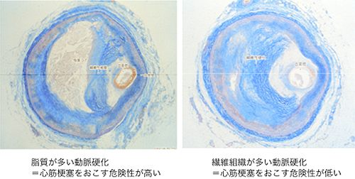 脂質が多い動脈硬化と繊維組織が多い動脈硬化