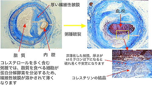 コレステロールを多く含む粥腫