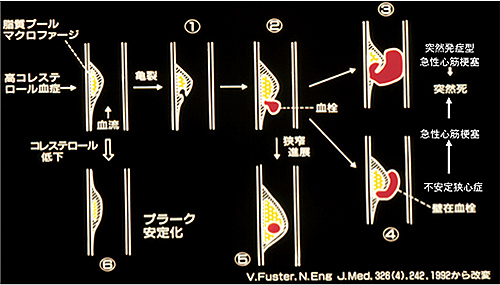 粥腫が破れた後の血栓のでき方