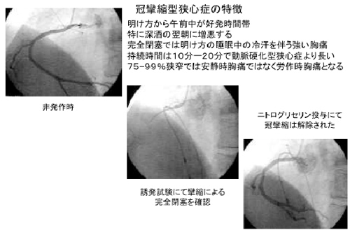 冠攣縮型狭心症の特徴