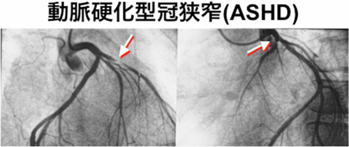 動脈硬化型冠狭窄（ASHD）