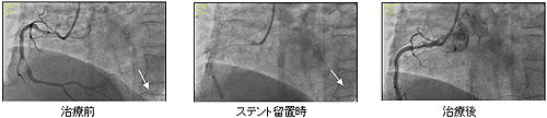 カテーテル治療の例