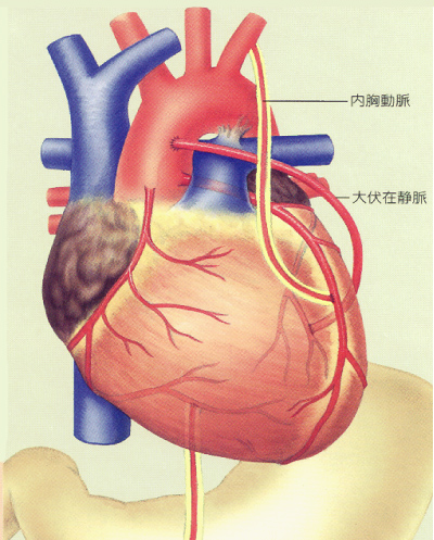 冠動脈バイパス術(CABG)