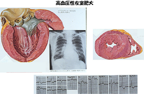 高血圧性左室肥大