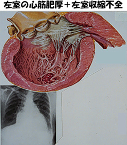 左室の心筋肥厚＋左室収縮不全