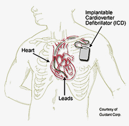 ICD(植込み型除細動器)