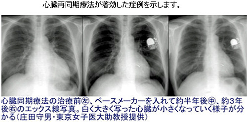 心臓再同期療法が著効した症状