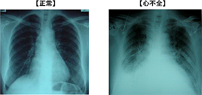正常・心不全